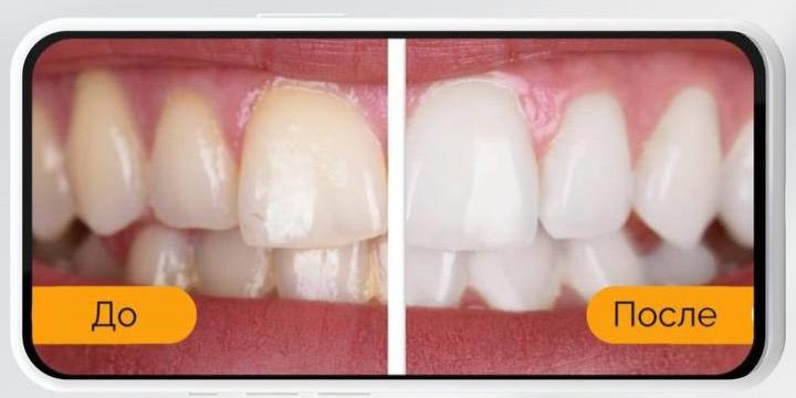 Отбеливание зубов в Самаре: как вернуть белизну после летних удовольствий