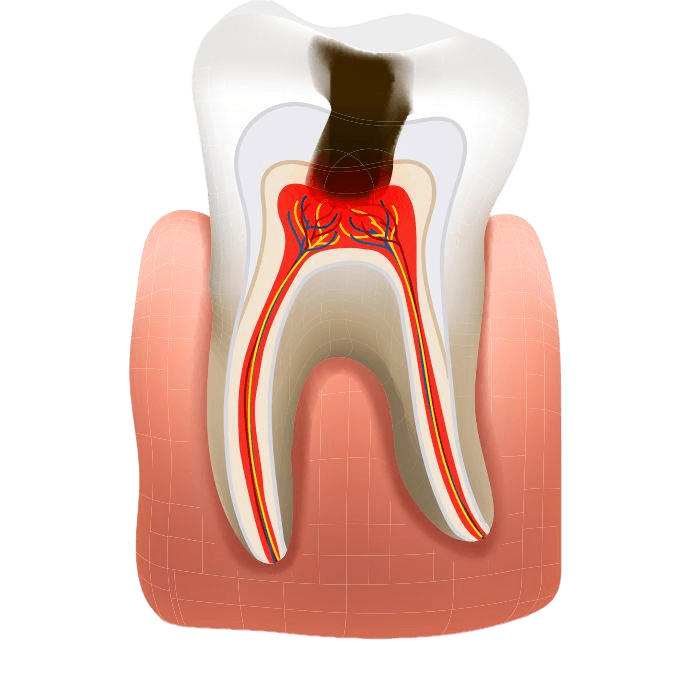 ЛЕЧЕНИЕ ПУЛЬПИТА