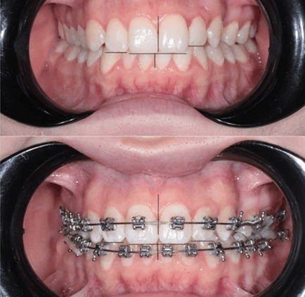 БРЕКЕТ-СИСТЕМА НА ОДНУ ЧЕЛЮСТЬ