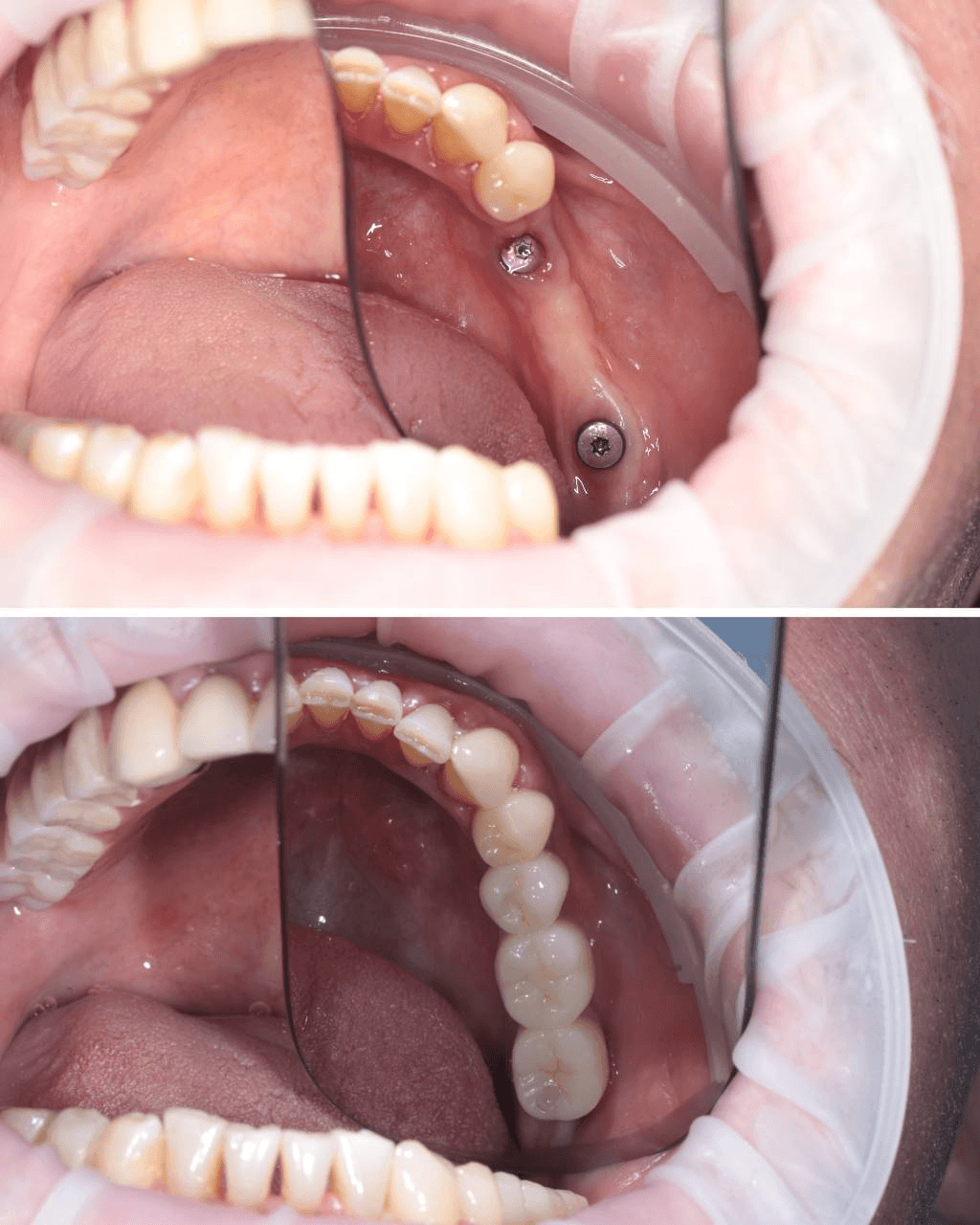 ПРОТЕЗИРОВАНИЕ НА ИМПЛАНТАТАХ